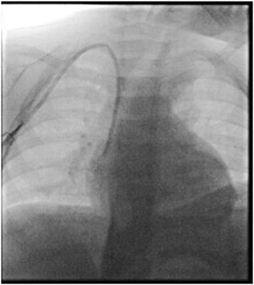 Case report: Bilateral pleural effusion secondary to late migration of a tunneled <mark class="highlighted">central venous catheter</mark> in a patient affected by high risk neuroblastoma
